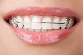 83-retainers Drobocky Orthodontics Bowling Green KY