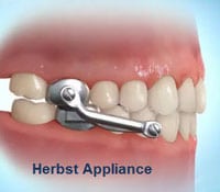 Herbst Appliance