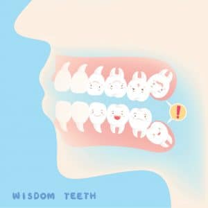 Wisdom teeth Bowling Green KY