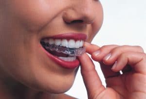 woman inserting clear aligner